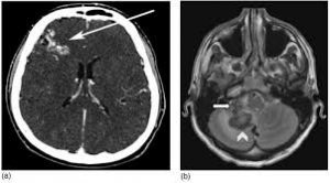 Cerebral venous thrombosis - Hình ảnh minh họa